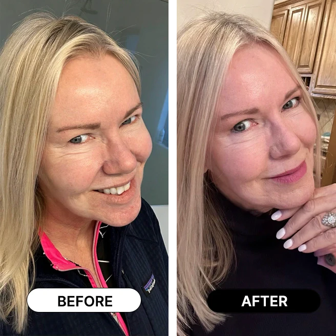 South Beach Collagen Filler Serum befor and after
